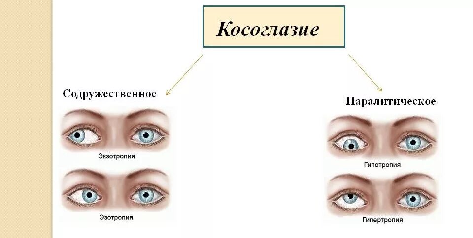 Паралитическое сходящееся косоглазие. Причины содружественного косоглазия. Сходящееся содружественное косоглазие у детей. Классификация косоглазия офтальмология. Косит глаз причины