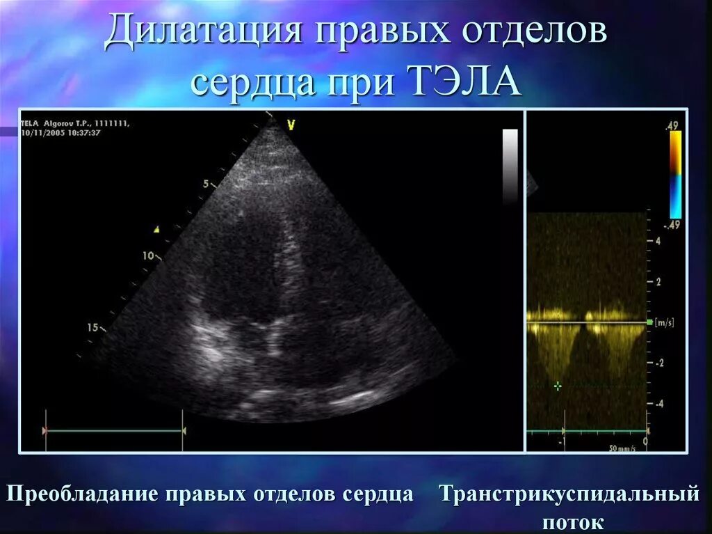 Дилатация правых отделов. Дилатация правых отделов сердца у новорожденных. Дилатация правого желудочка. Дилатация всех отделов сердца. Дилатация полостей предсердий