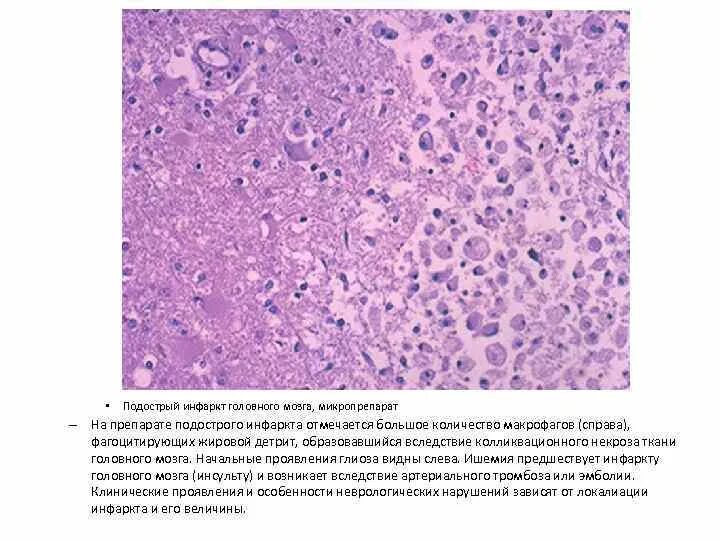 Микропрепарат головного мозга. Ишемический инфаркт головного мозга микропрепарат патанатомия. Ишемический инфаркт головного мозга микропрепарат рисунок. Ишемический инсульт макропрепарат. Колликвационный некроз гистология.