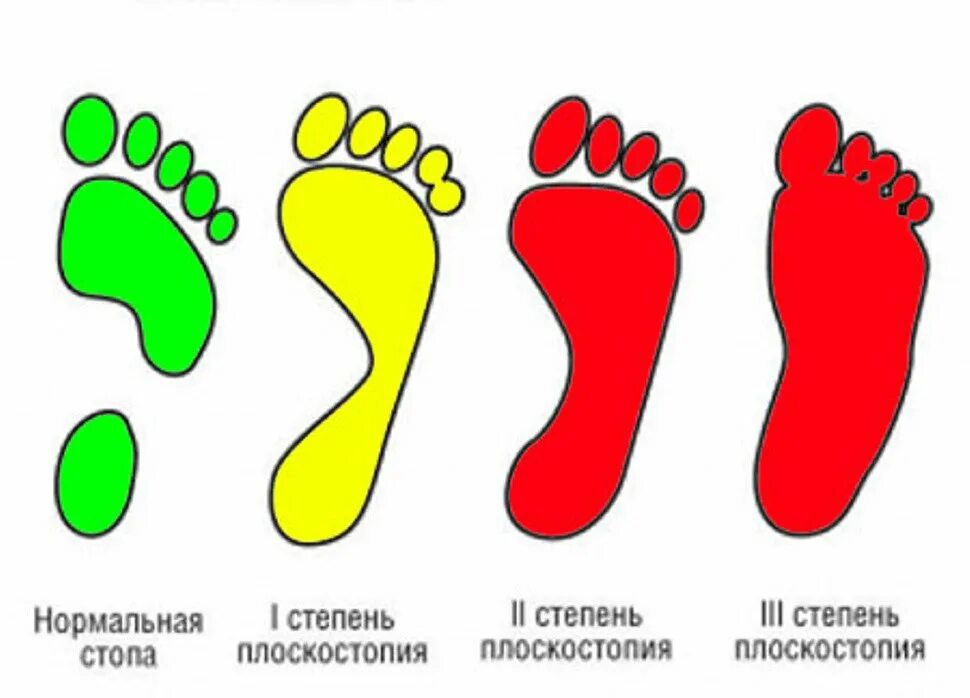 Степени плоскостопия 3 степени. Плоскостопие 1, 2, 3 степени. Плоскостопие 1 степени 2 степени. Продольно-поперечное плоскостопие и вальгус 3 степени. 3 типа стопы