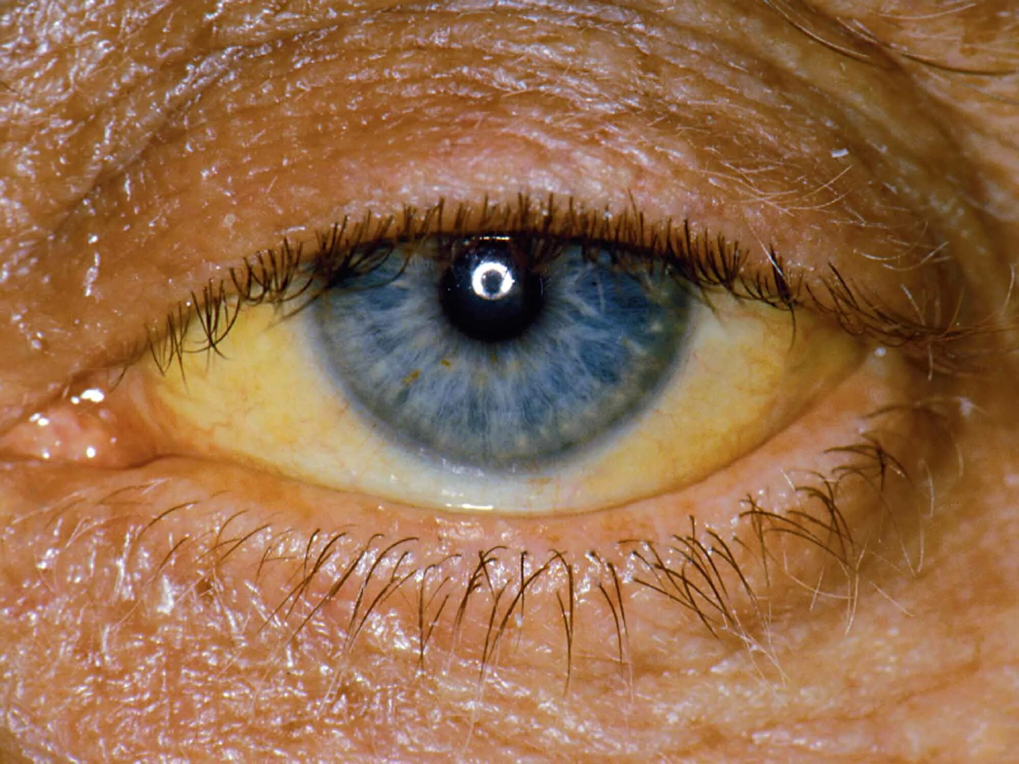 Желтый глаз 14. Иктеричность кожных склер. Синдром Жильбера склеры.