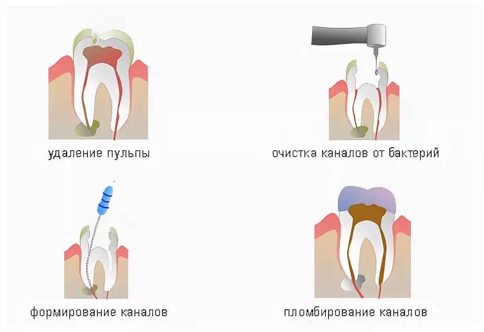 Временное пломбирование корневых каналов. Корневой канал при воспалении пульпы пломбируют. Инструменты для удаления пульпы из корневых каналов. Лечение корневых каналов зуба.