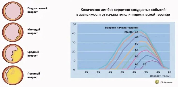 Москва лечение атеросклероза. Москва лечение атеросклероза