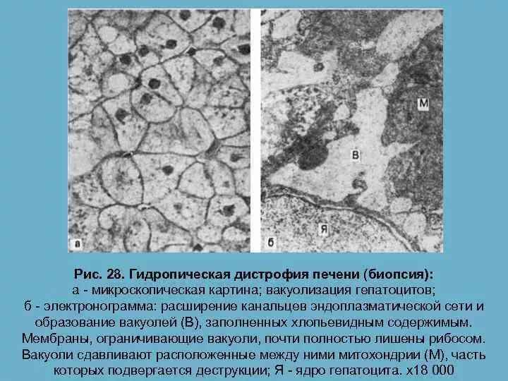 Митохондрии в клетках печени. Гидропическая (баллонная дистрофия) печени. Исчерченный проток Электронограмма гистология. Печень гистология Электронограмма. Гидропическая дистрофия печени микропрепарат.