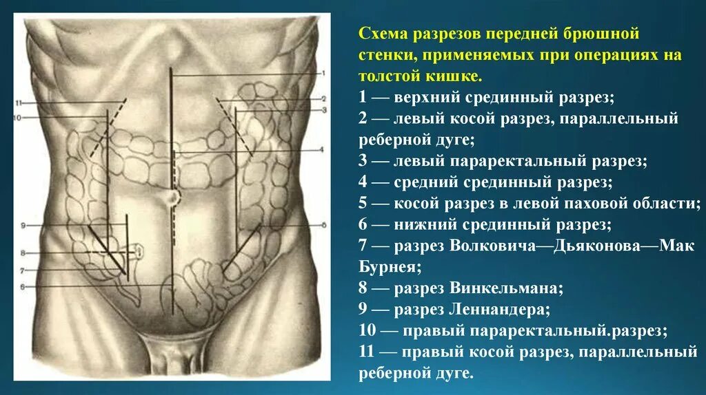 Области брюшной стенки живота. Разрез Волковича Мак-Бурнея. Срединный разрез брюшной полости. Схема разрезов передней брюшной стенки. Параректальный разрез передней брюшной стенки.