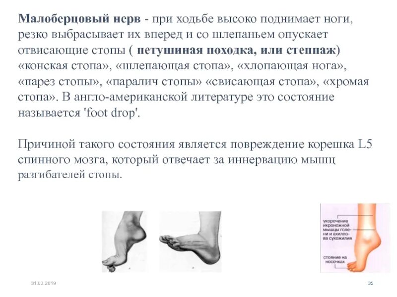 Парез стопы. Невропатия малоберцового нерва. Повреждение общего малоберцового нерва. Повреждение поверхностного малоберцового нерва стопа. Поражение малоберцового нерва симптомы.