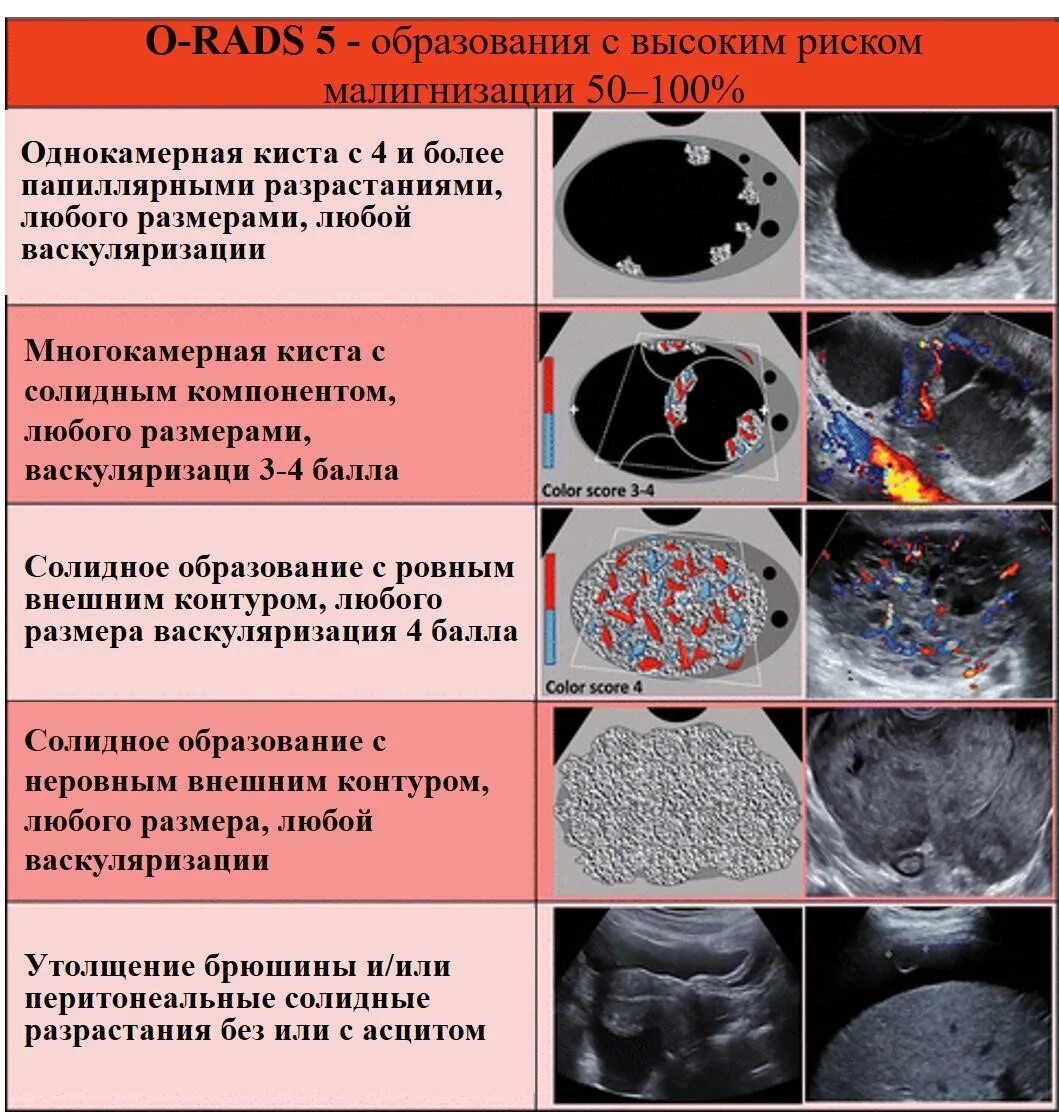 O rads классификация. Классификация o-rads для УЗИ. O rads классификация яичников. Классификация bi rads.