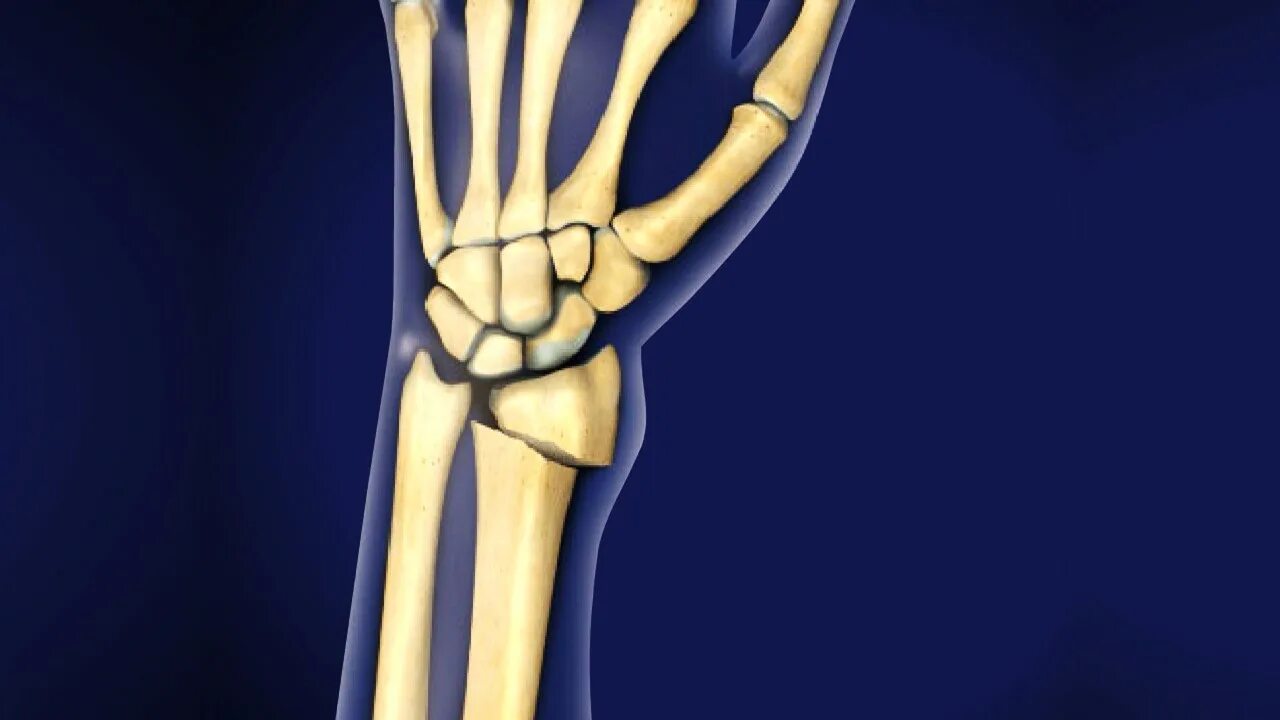Radius fracture
