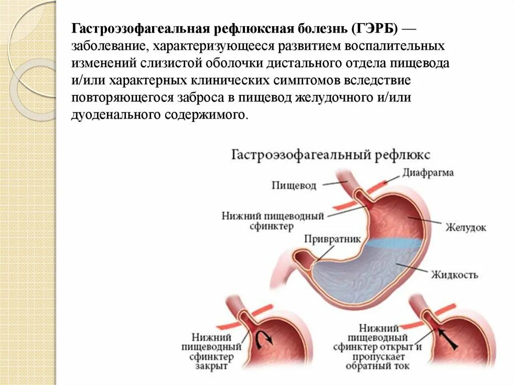 Заброс содержимого желудка в пищевод. Гастроэзофагеальная-рефлюксная болезнь ФГДС. Рефлюксная болезнь желудка рефлюкс. Рефлюксная болезнь сфинктер. Симптомы гастроэзофагеальной рефлюксной болезни.