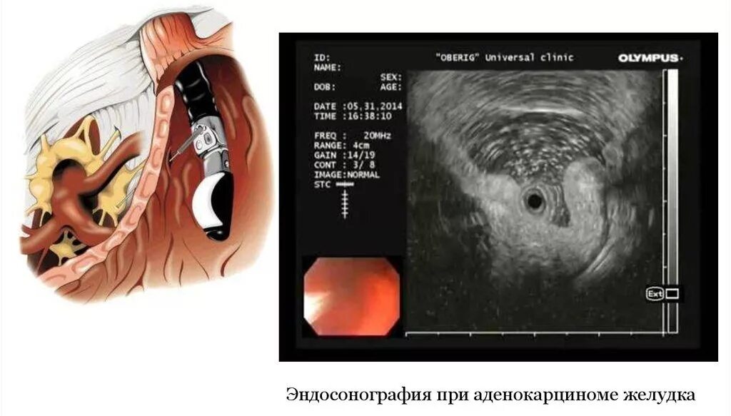 Эус желудка. Эндоскопическая ультрасонография поджелудочной железы. Эндоскопическая ультрасонография пищевода. Эндоскопическая ультрасонография хронический панкреатит. Эндоскопическое исследование УЗИ желудка.