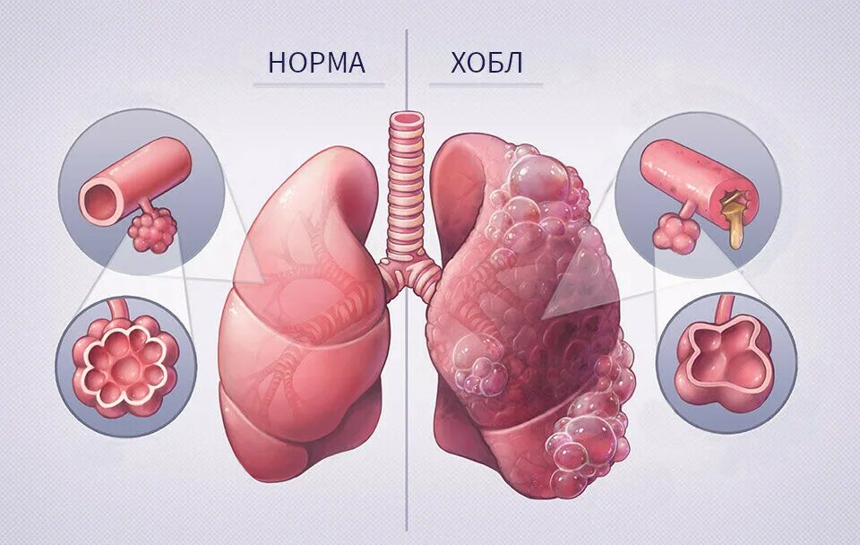 Хронические легочные заболевания