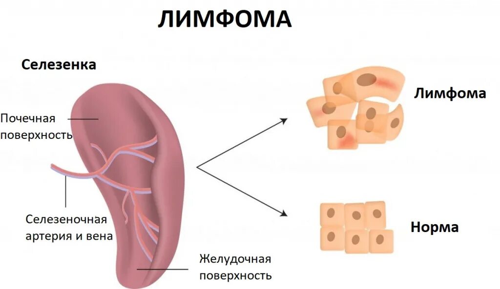 Развитие селезенки анатомия. Инфаркт селезёнки симптомы.