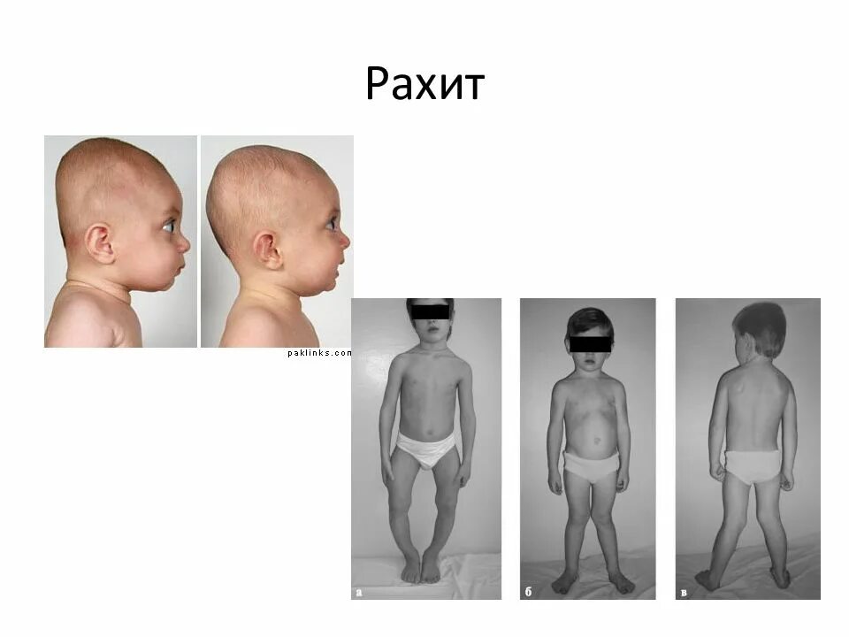Как выглядит рахит у детей
