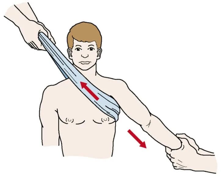 Лечение плеча после вправления. Вывих плечевого сустава вправление. Вывих плечевого сустава вправить. Передний вывих плечевого сустава вправление. Методы вправления вывиха плеча.