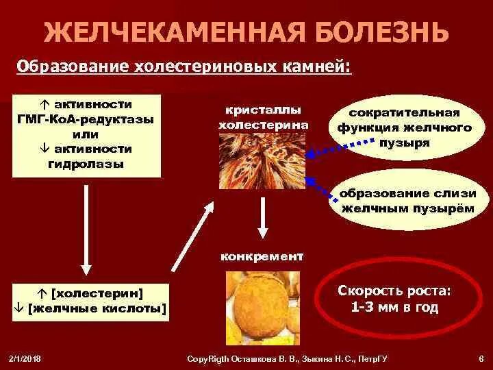 Причины жкб. Механизм развития желчекаменной болезни биохимия. Механизм образования желчных камней. Механизм образования желчных камней биохимия. Причины образования желчных камней.