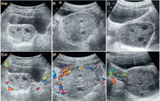 На узи не виден яичник. Стромальный текоматоз яичников УЗИ. Поликистоз яичников на УЗИ. Поликистозные яичники на УЗИ.