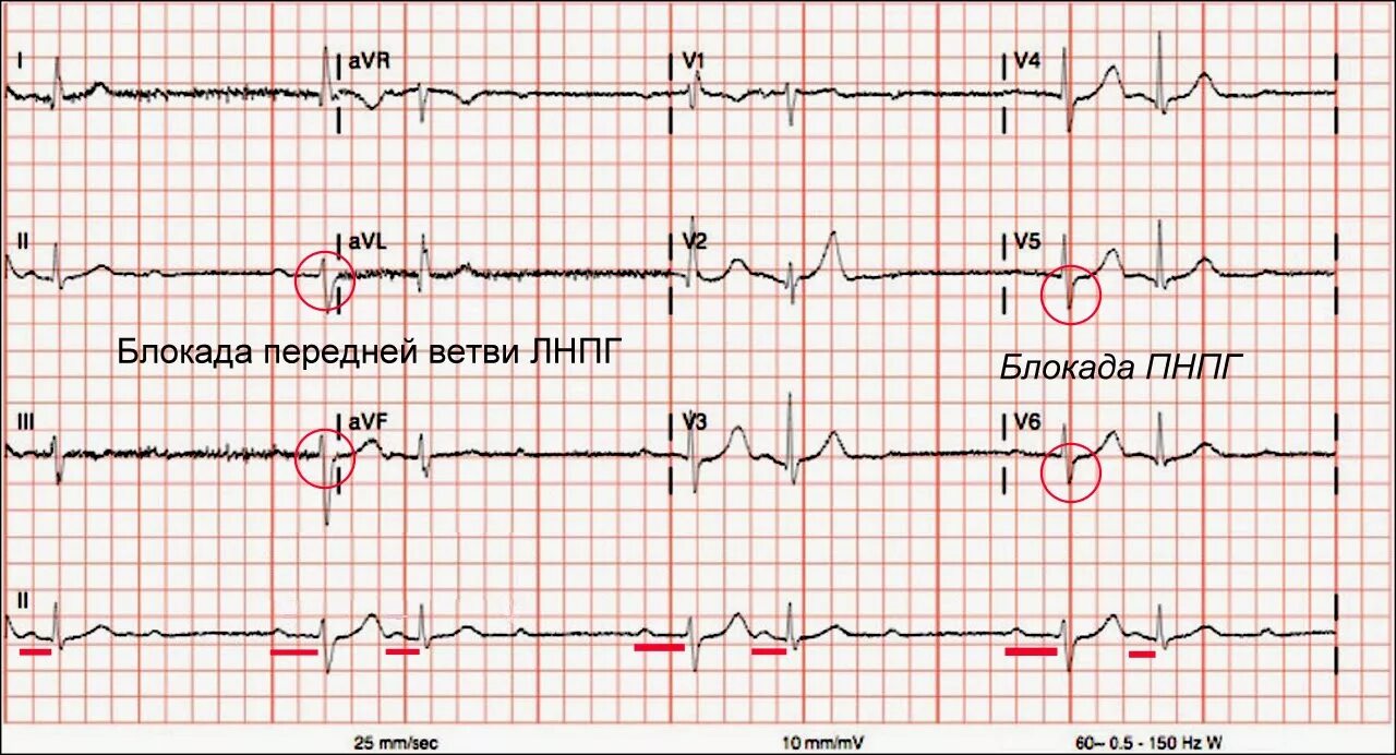 Блокада передне лнпг. Неполная блокада передней ветви ЛНПГ на ЭКГ. ЭКГ при блокаде ветвей левой ножки пучка Гиса. ЭКГ при блокаде передней ветви левой ножки пучка Гиса. Блокада передней ветви ЛНПГ на ЭКГ.