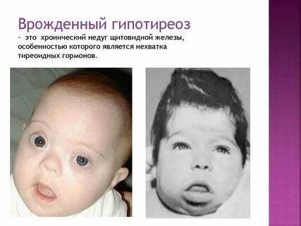 Гипотиреоз у новорожденных симптомы