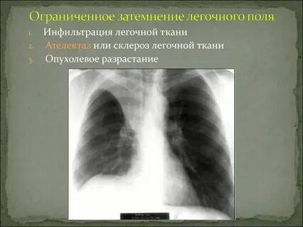 Участки инфильтрации легочной ткани