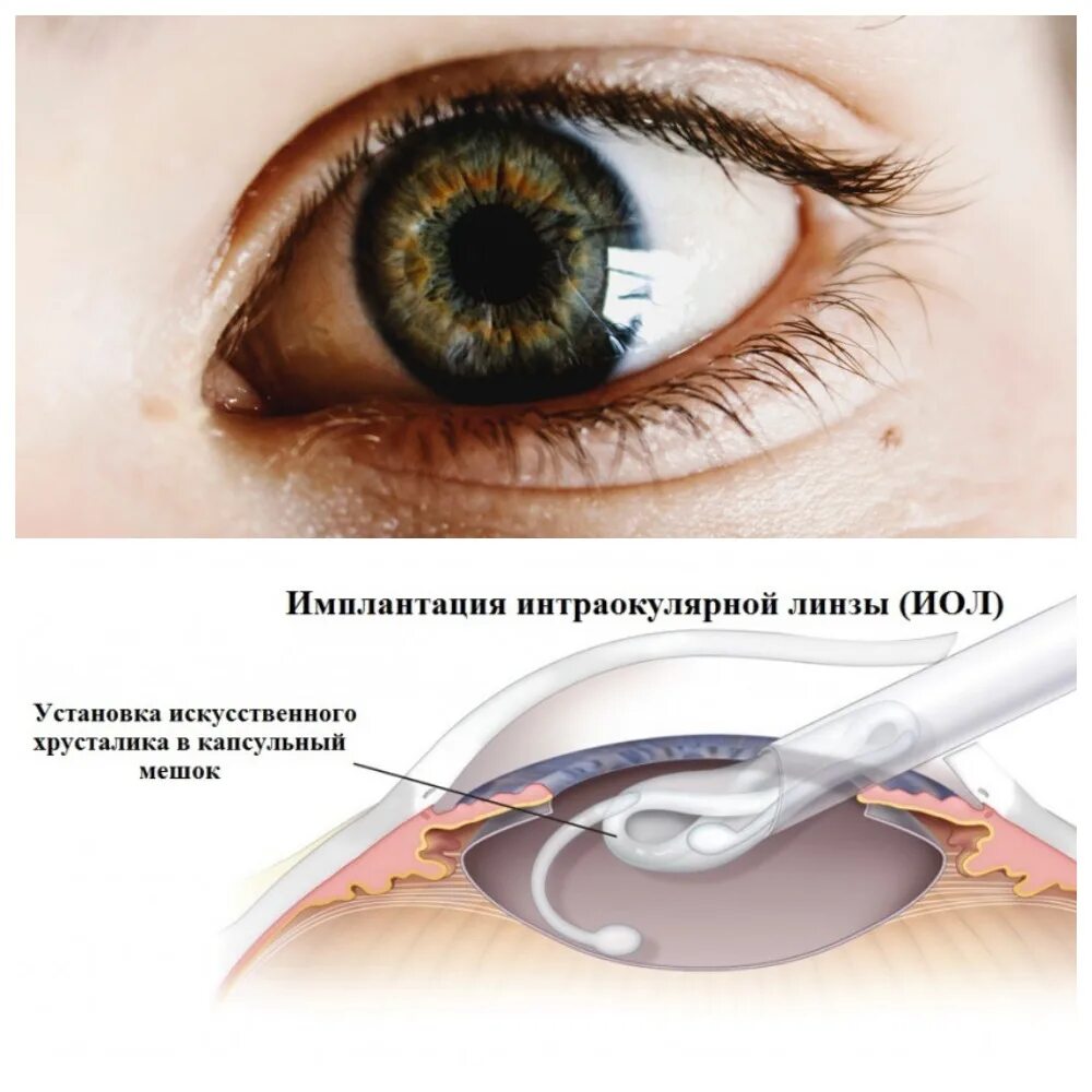 Замена хрусталика глаза как проходит операция. Подвывих хрусталика при катаракте. Сублюксация хрусталика. Искусственный хрусталик. Искусственный хрусталик глаза.