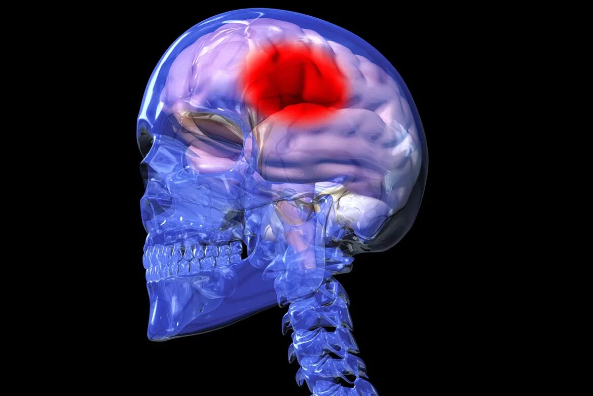 Кровоизлияние в головной мозг. Внутреннее кровотечение мозга.
