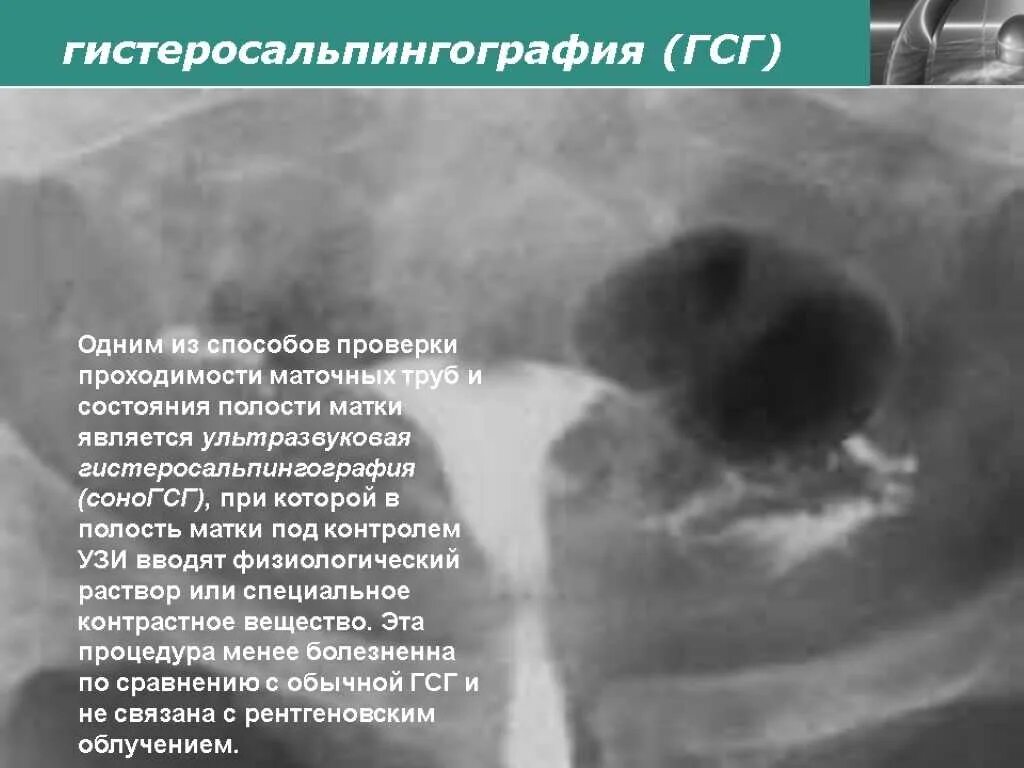 Забеременела при непроходимости труб. Исследование проходимости маточных труб (гистеросальпингография. Непроходимость маточных труб УЗИ. ГСГ проходимость маточных труб.