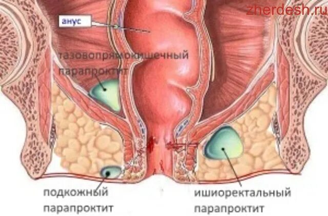 Ощущение в прямой кишке. Гнойный ишиоректальный парапроктит. Острый Гнойный подкожно подслизистый парапроктит. Пельвиоректальный парапроктит. Парапроктит параректальные свищи.