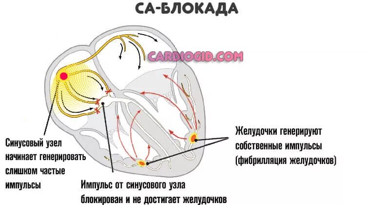 Блокада узла. Блокада са узла 2 степени. Блокада са узла ЭКГ. Блокада синусового узла 2 степени. Синоаурикулярная блокада 2 степени.