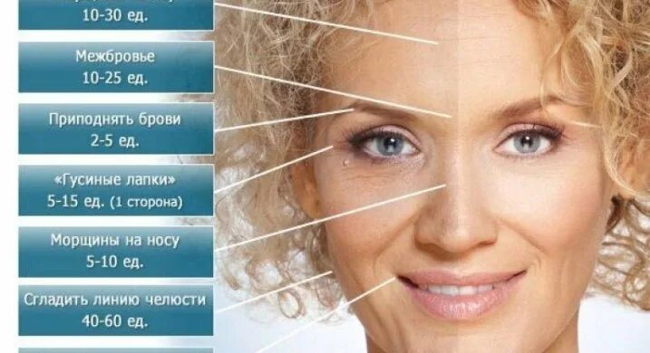 Сколько единиц ботокса в межбровье. Точки диспорта для поднятия бровей. количество единиц ботокса. сколько надо единиц ботокса для лба.