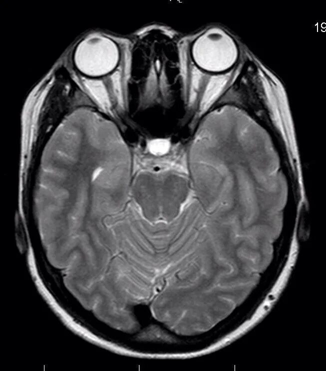 Мрт глазного нерва. Мрт головного мозга и глазных орбит. Мрт головного мозга и мрт орбит. Мрт глазных орбит и зрительных нервов. Опухоль глазных орбит на мрт.