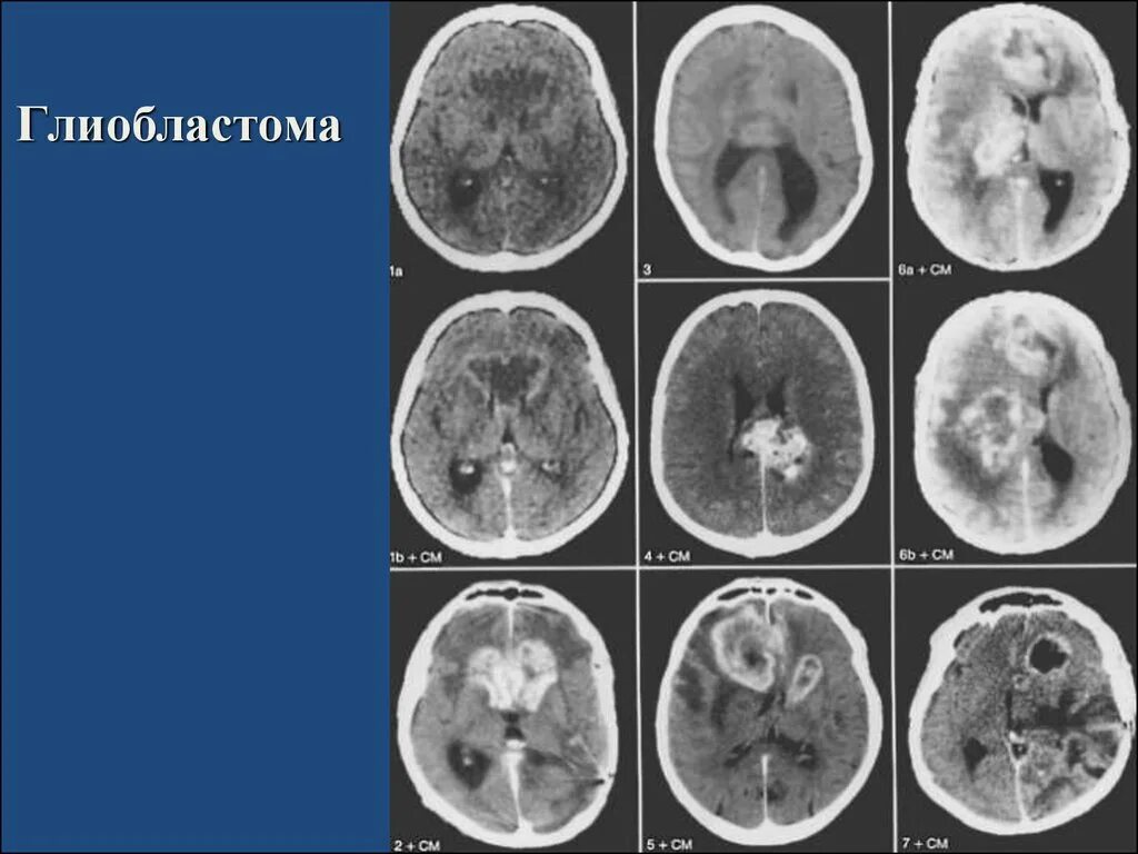 Глиобластома головного мозга на кт. Глиобластома головного мозга мрт. Мультиформная глиобластом. Глиобластома на мрт мозга. Симптомы глиобластомы головного