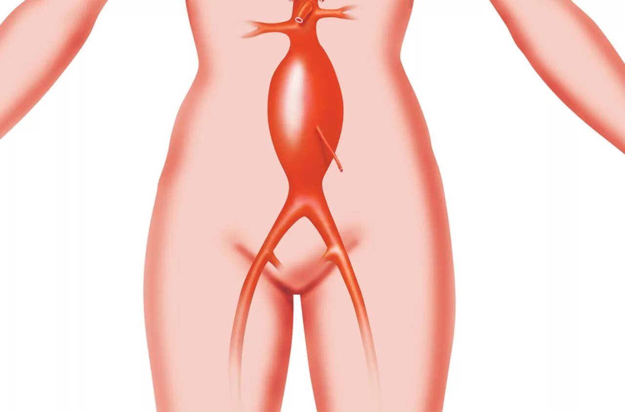 Аорта брюшной полости операция. Аневризма брюшной аорты. Аневризма аорты брюшной полости. Аневризма брюшной аорты симптомы разрыв. Аневризм брюшной аорты симптомы.