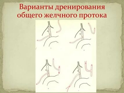 Дренирование желчных протоков