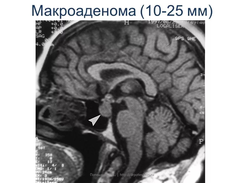 Опухоль гипофиза. Микроаденома гипофиза мрт диагностика. Пролактинома гипофиза кт. Супраселлярная аденома гипофиза мрт. Кортикотропинома гипофиза.