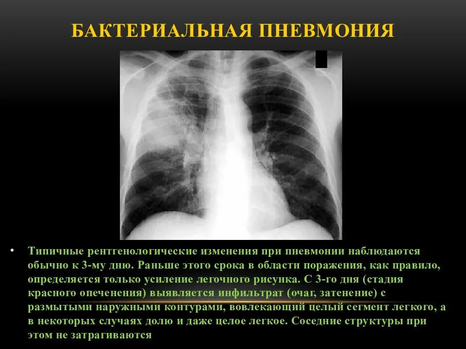 Очаговый бронхит. Бактериальная пневмония снимок. Бактериальная пневмония на кт лёгких. Пневмония бактериальная компьютерная томография. Рентген при бактериальной пневмонии.