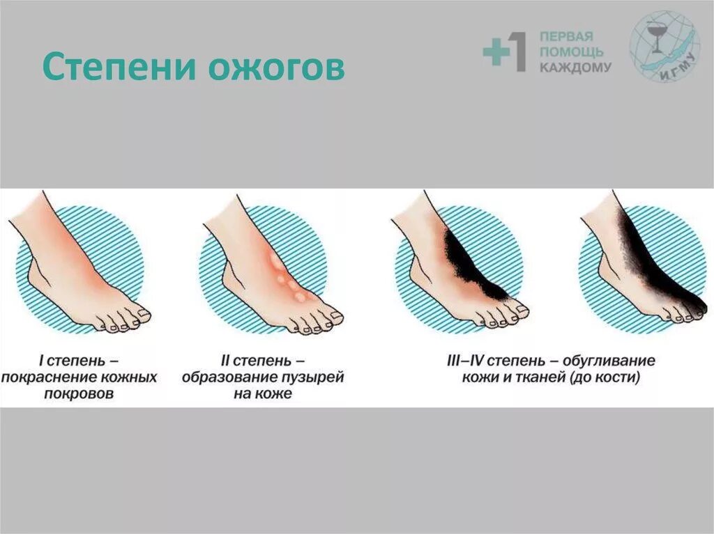 Какие степени термического. Ожоги разной степени тяжести.