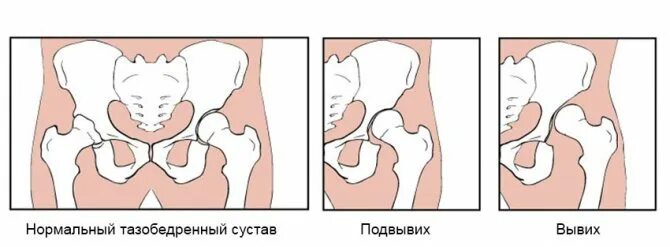 Незрелость тазобедренных суставов в 1 месяц. Незрелость тазобедренных суставов дисплазия. дисплазия тазобедренных суставов у новорожденных подвывих. подвывих тазобедренного сустава у детей до года. незрелый тазобедренный сустав.