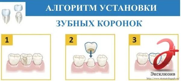 Почему ставят коронки. Установление коронки на зуб. Как ставится коронка на зуб. Процесс установления коронки на зубы.