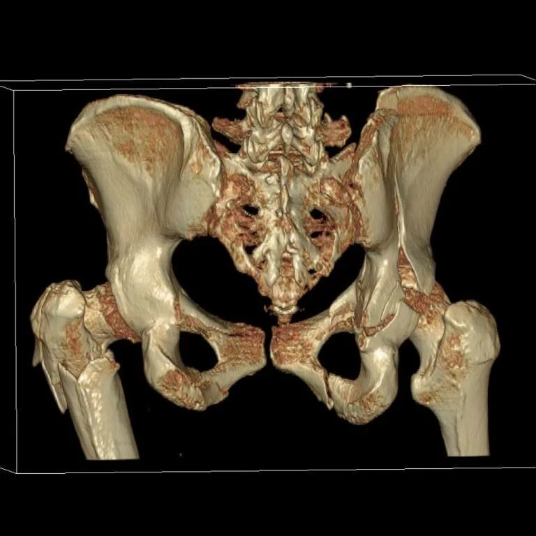 В костях и т д. Болезнь Педжета костей таза. МСКТ тазобедренного сустава. Кт костей таза перелом лонной кости. Остеосаркома тазобедренного сустава кт.