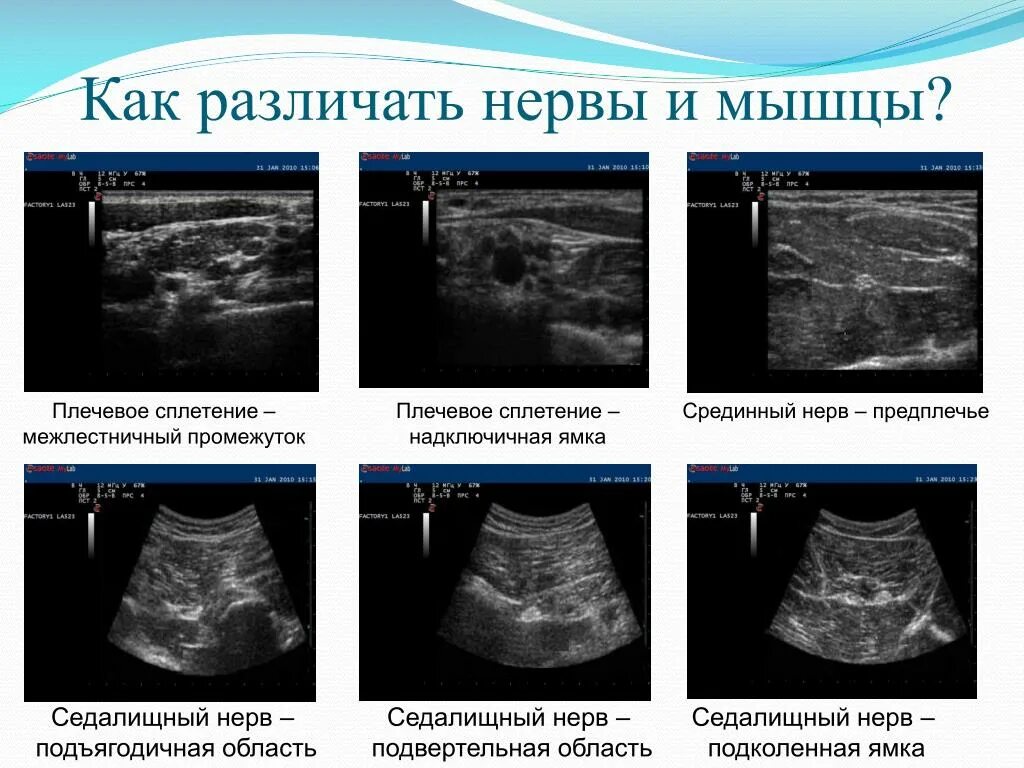 Блокада под узи. Блокада плечевого сплетения под УЗИ. Надключичная блокада плечевого сплетения под УЗИ. Блокада под контролем УЗИ. Межлестничная блокада плечевого сплетения под УЗИ.