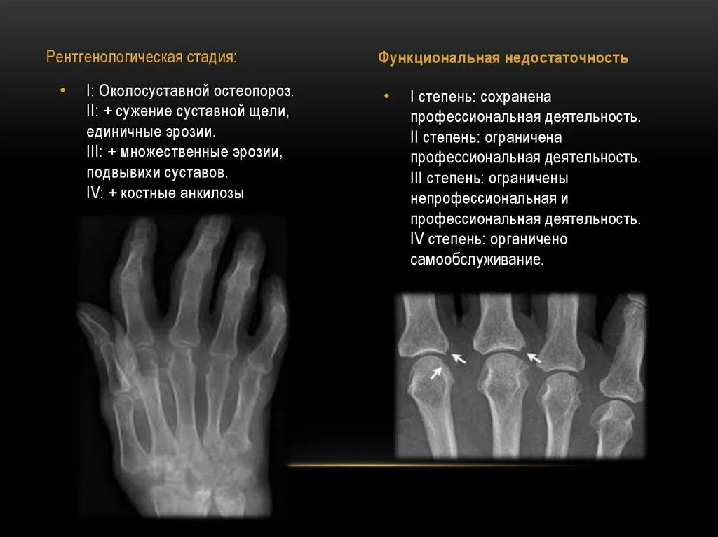 Артрит рентгенологические стадии. Ревматоидный артрит рентген кистей околосуставной остеопороз. Ревматоидный артрит кисти рентген стадии. Ревматоидный артрит 1 стадия на рентгене. Ревматоидный артрит плюснефаланговых суставов рентген.