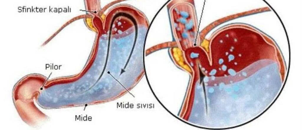 Рефлюкс заброс. Желудочно-пищеводный рефлюкс. Рефлюкс желудочного содержимого в пищевод.