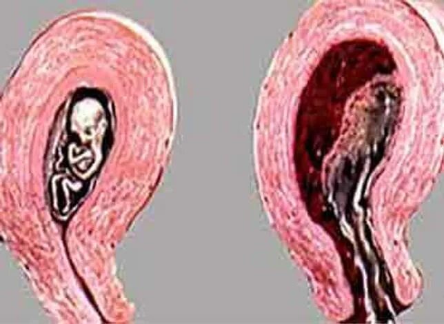 Плод в полости матки. Самопроизвольный выкидыш на раннем.