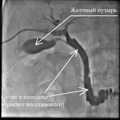 Эндоскопическое стентирование холедоха. Стентирование желчного протока. Эндоскопическое стентирование желчных протоков. Баллонной дилатации стентирование желчных протоков. Стент желчного протока