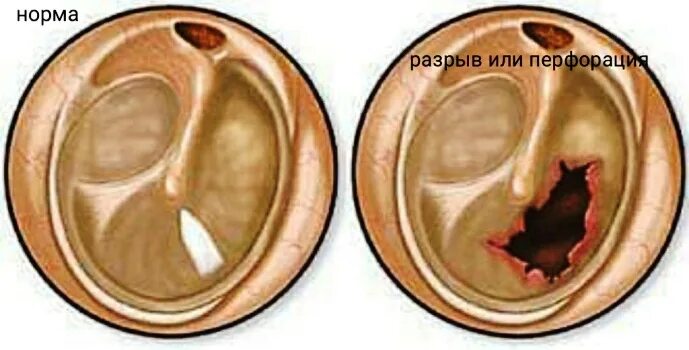 Отит у ребенка до года - симптомы и причины возникновения у детей, признаки част