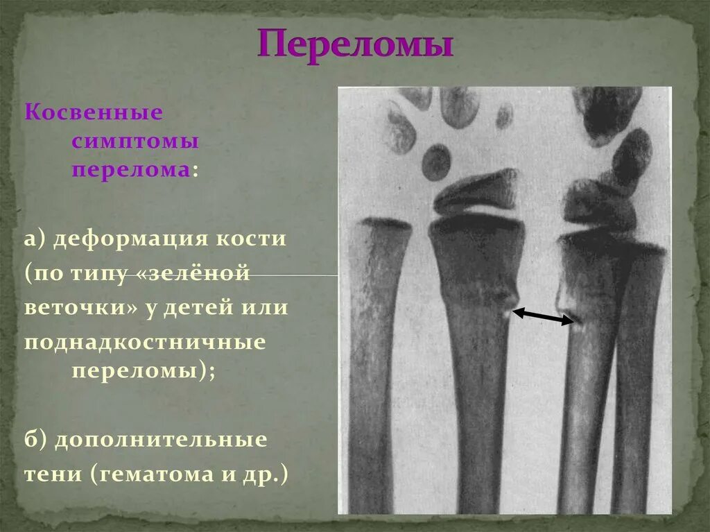 Поднадкостничный перелом по типу зеленой веточки. Перелом по типу зеленой веточки у детей. Перелом по типу зеленой ветки большеберцовой кости. Поднадкостничный перелом. Симптомы перелома или трещины