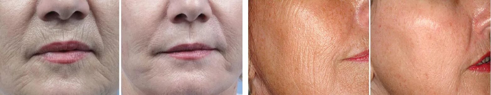 Фракционная мезотерапия для лица до и после ❗ ❗ ❗ Micronidling is slowly but surely gaining popularity. Not surprisingly, be