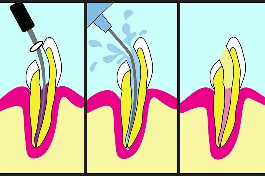Пломбирование канала зуба гуттаперча+паста. Пломбировка каналов зуба гуттаперчевыми штифтами. Пломбирование гуттаперчей моноштифт. Пломбирование корневого канала зуба. Пломбирование зуба после лечения каналов