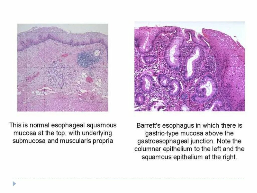 Метаплазия гистология. Пищевод Барретта патологическая анатомия. Пищевод Барретта метаплазия эпителия. Пищевод Барретта гистология.
