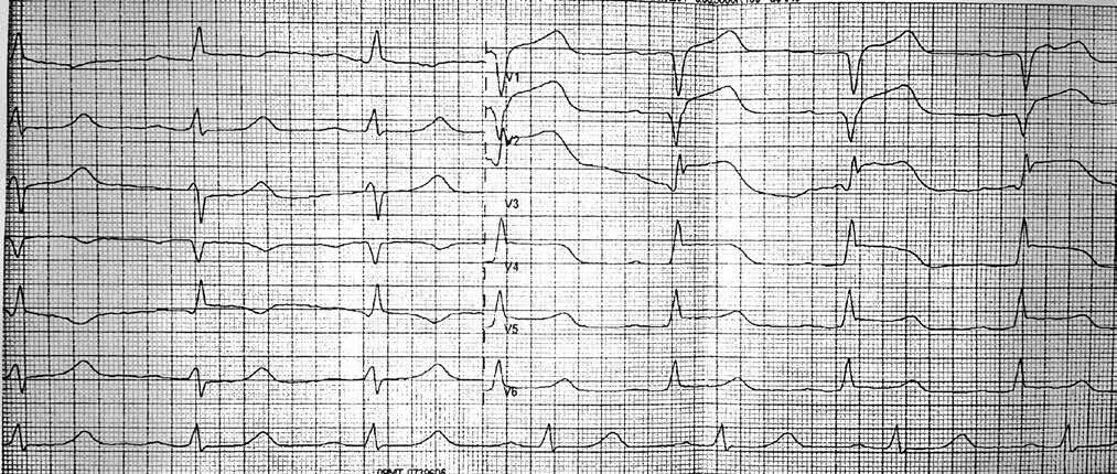 Элевация сегмента ст на ЭКГ. Инфаркт ЭКГ элевация St. Элевация St на ЭКГ. Элевация сегмента St на ЭКГ v2 v3. Без подъема st на экг